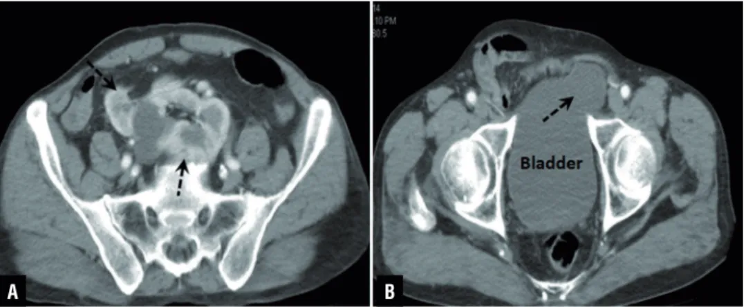 Figure 1 - Axial CT images show pancake kidney and bladder herniation (dashed arrows).