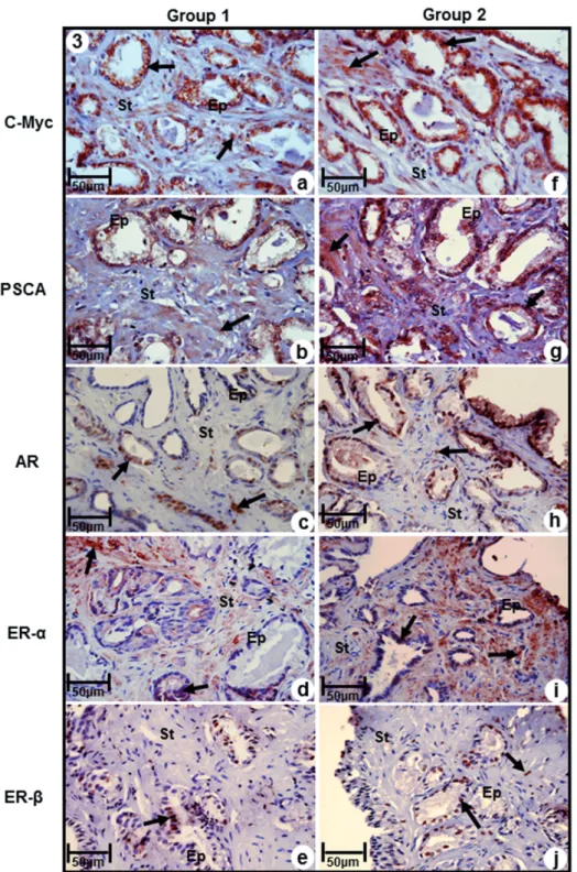 Figure 3 - Immuno-staining of antigens C-Myc, PSCA, AR, ERα and ERβ in prostatic peripheral zone of Groups 1 (a, b, c,  d, e) and 2 (f, g, h, i, j)