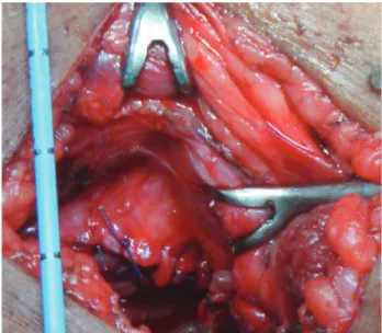 Figure 2 - Antegrade DJ stent placement.