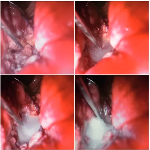 Figure 3 - Injection of fibrin glue between vesical and rectal wall.