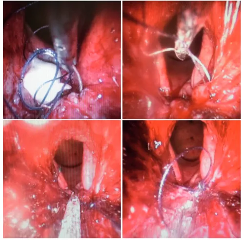 Figure 4 - Rectal wall closed.