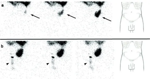 Figure 1 - Dynamic peritoneal 99mTc-Phytate scintigraphy. Panel a: Images acquired during the filling of peritoneal dialysis  solution (600, 1200 and 2000 ml) labeled with 74 MBq of 99mTc Phytate, revealing a hypogastric uptake of radiotracer (arrow),  not