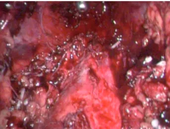 Figure 2 - Major vessels after lymphadenectomy.