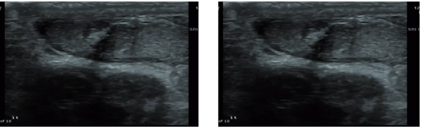 Figure 1 - Leydig cell tumor - Heterogeneous mass that was suspected for malignancy eventually found to be Leydig cell  tumor with similar size estimated preoperatively.