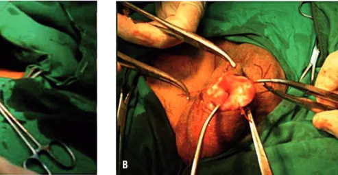 Figure 2B - An operative photograph showing in situ excision  of the hydrocele sac using electrocautery.