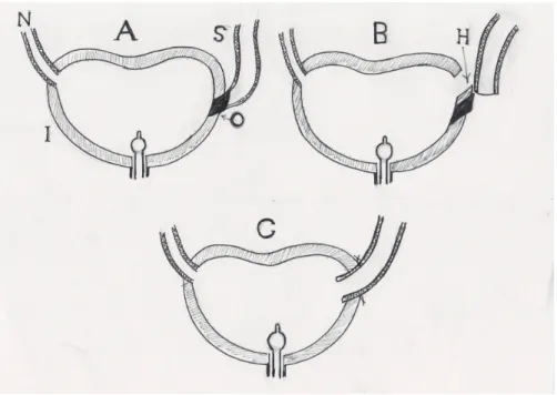 Figure 4 - Dipping technique. (A) The stenosed long ureter and short obliterated segment