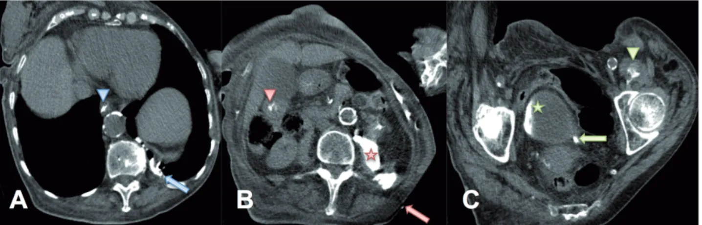Figure 1 - Fistulogram showing nephrocutaneous fistula with contrast leakage cranially (blue arrow) and caudally (red  arrow) from the kidney.