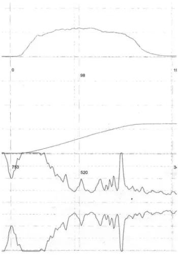 Figure 1 - A sample of flowmetry/EMG in a patient with  documented DO, showing a negative lag time.