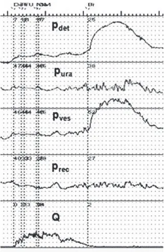Figure 1 - Recording of a typical example of detrusor  after-contraction (DAC) observed during intubated flow of  a female patient