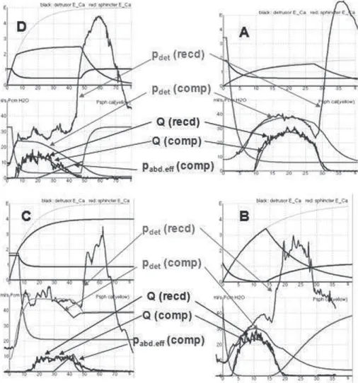 Figure 2 - Four examples of VBN analysis of voidings followed by detrusor after-contraction (DAC) in female patients