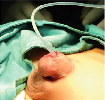 Figure 2 - Intraoperative view. First Foley catheter was  inserted under the dorsal penile skin at 11 o’clock position.