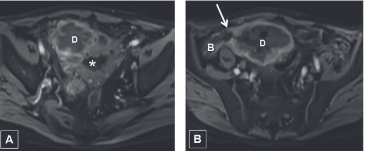 Figure 1 - Enterovesical fistula secondary to diverticulitis. T1-weighted axial MR images (A-B) with intravenous contrast  medium shows thick-walled diverticulum (D) and fistula track (arrow) between diverticulum (D) and bowel (B)