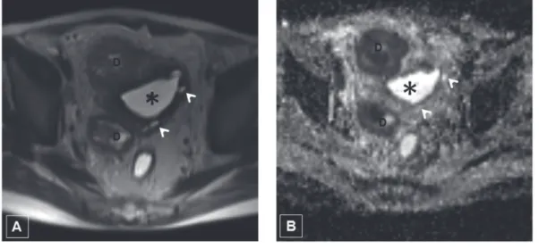 Figure 2 - Axial T2-weighted MR image (A) shows multiple bladder diverticula (D) and pseudodiverticula (arrowheads)