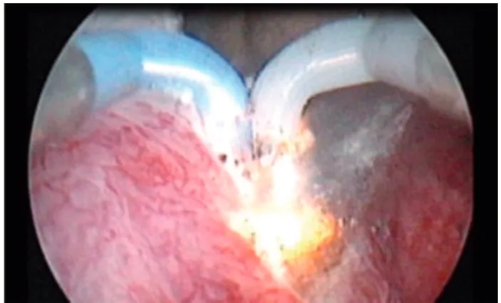 Figure 2 - Transurethral PKVP of the right lobe of the  prostate.