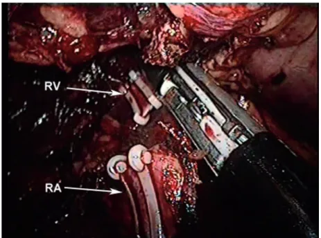 Figure 2 - The renal artery (RA) and renal vein (RV) were clipped with Hem-o-lok clips and divided by LigaSure.