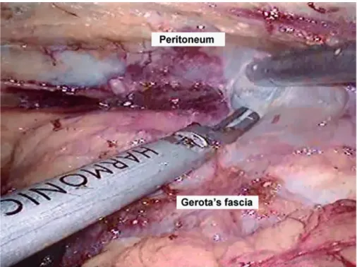 Figure 3 - Dissection of the diseased kidney outside the Gerato’s fascia.