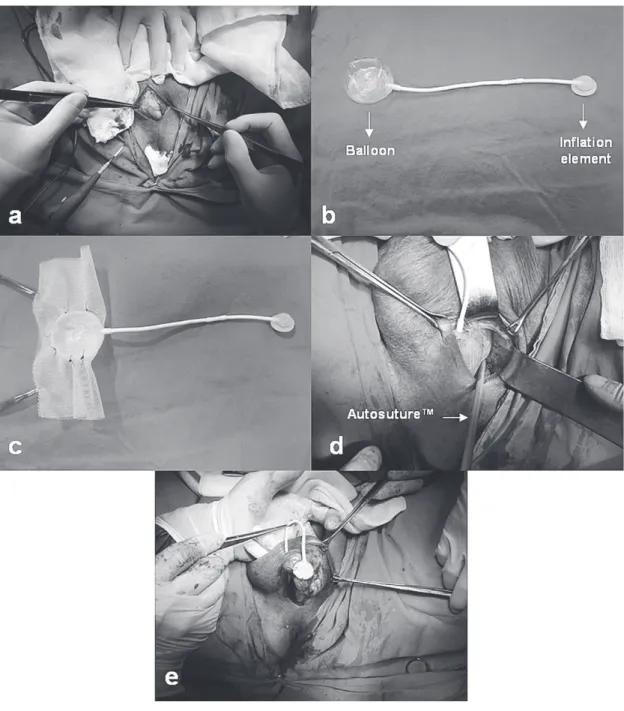 Figure 1 - a) Both sides of urethra are dissected; b) A balloon expander; c) A balloon expander between two layers of the  mesh; d) The mesh is stapled to the pubic bone using Autosuture Stat Tack TM ; e) Prepared scrotal pouch for placing the  inflation c
