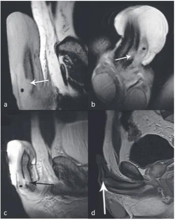 Figure 1 - A 37-year-old patient with penile fracture of the left  corpus cavernosum. (a) Sagittal T1-weighted image shows  a rupture of the tunica albuginea (arrow) and a haematoma  extending into the corpus cavernosum (asteriks)