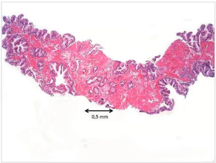 Table 2 - Clinicopathologic findings on needle biopsy of  17 patients with insignificant cancer in comparison with  Epstein’s criteria predictive of insignificant cancer in  surgical specimens.