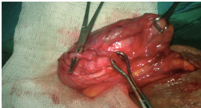Figure 1 - Vas deference inserted to testis directly.