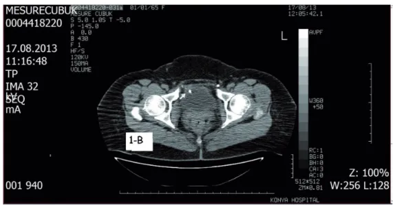 Figure 1c - CT image of normally localized endotackers.