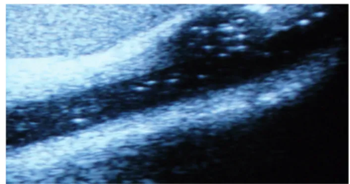 Figure 3  -  Same stricture as seen in sono-urethrogram.