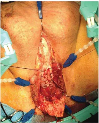 Figure 1 - Urethrotomy and hemostatic sutures.