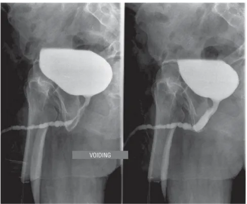 Figure 4 - Panurethral stenosis. Voiding urethrography.