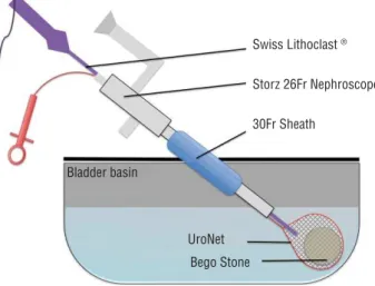 Figure 1 - Schematic bladder stone model.