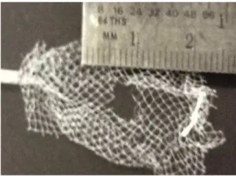 Figure 2 - UroNet Retriever with 4 mm mesh defect after  lithotripsy.