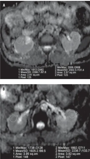Figure 1 - 56 years old male patient. Apparent diffusion  coefﬁcient (ADC) maps of treated and contralateral kidneys  before (Figure-1a) and after (Figure-1b) treatment with  ESWL