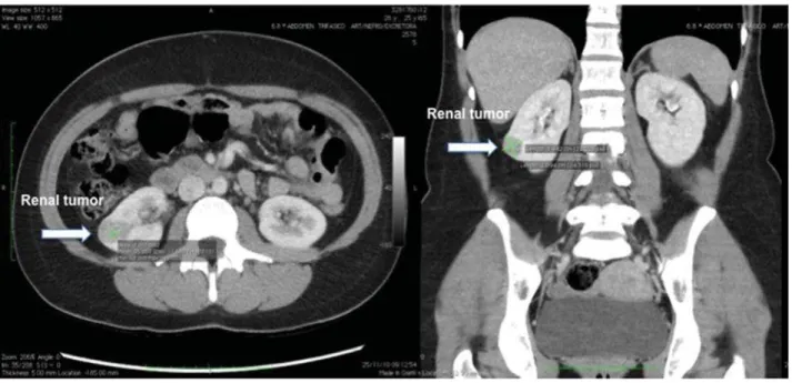 Figure 1 - Contrast-enhanced computed tomography reveals a 2.8 cm, well circumscribed, solid, hypoenhancing cortical  lower pole mass in the right kidney with 100 Hounsfield Units (axial and coronal view).