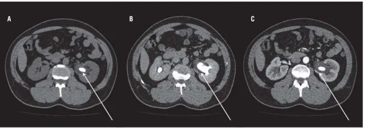 Figure 1 - Abdominal computed tomography (CT) revealed a 140 mm² stone in the left renal pelvis with 1500 Hounsﬁeld  Units (a); thickening of the urothelium surrounding the stone was suspected after contrast infusion (b) and conﬁrmed in the  excretory phas