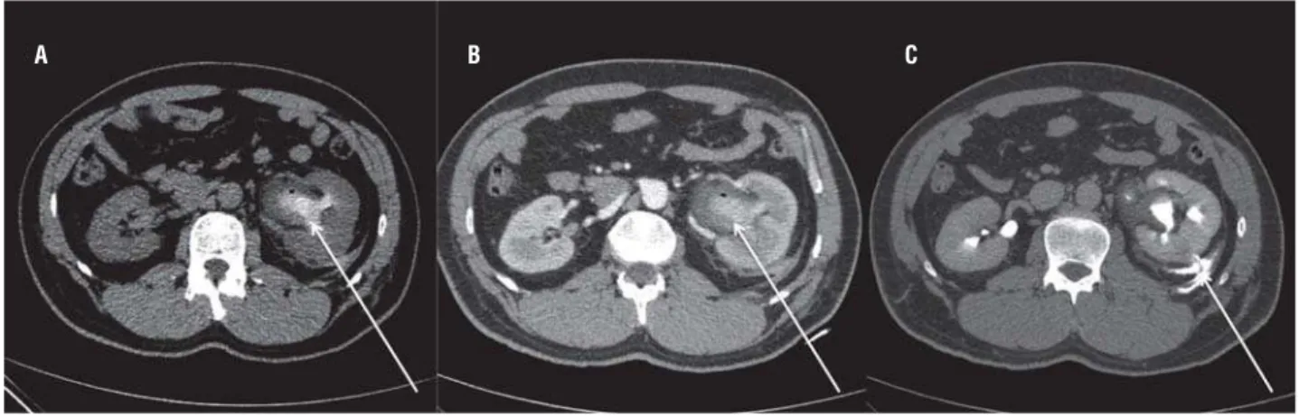 Figure 2 - Diagnostic CT scan showed no residual stones (a); nonetheless, signiﬁcant thickening of the urothelium  with hyperdense material indicative of blood clots in the collecting system (125 HU; b) and urinary extravasation to the  retroperitoneal spa