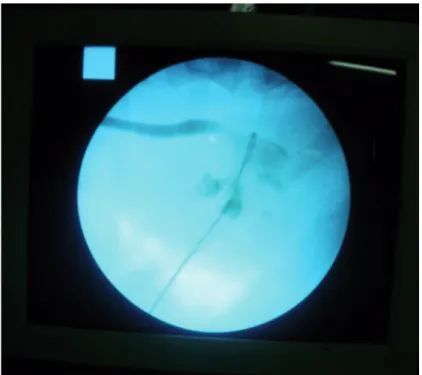 Figure 2 - Documentation of guide wire entry site and angle by fluoroscopy after injecting contrast media from ureteral  catheter