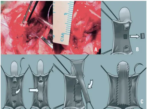 Figure 1 - Step-by-step description of the technique consisting of a tunica vaginalis flap for reconstruction of the corpora  after corporotomy
