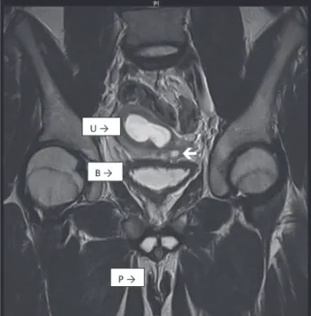 Figure 1 - MRI of the pelvis and abdomen of the patient,  showing the bladder (B), a single cervix and uterus (U),  and two tubular structures at the usual place of corpus  cavernosum (P)