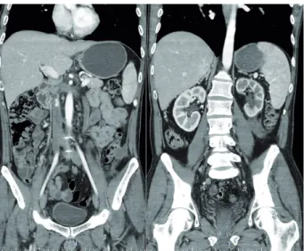 Figure 2 - Computerized tomography scan of the abdomen  demonstrating the inferior vena cava thrombus extended  from the left spermatic vein and bilateral external iliac  veins to the hepatic vein, no evidence of metastasis, and  the improvement of the lef