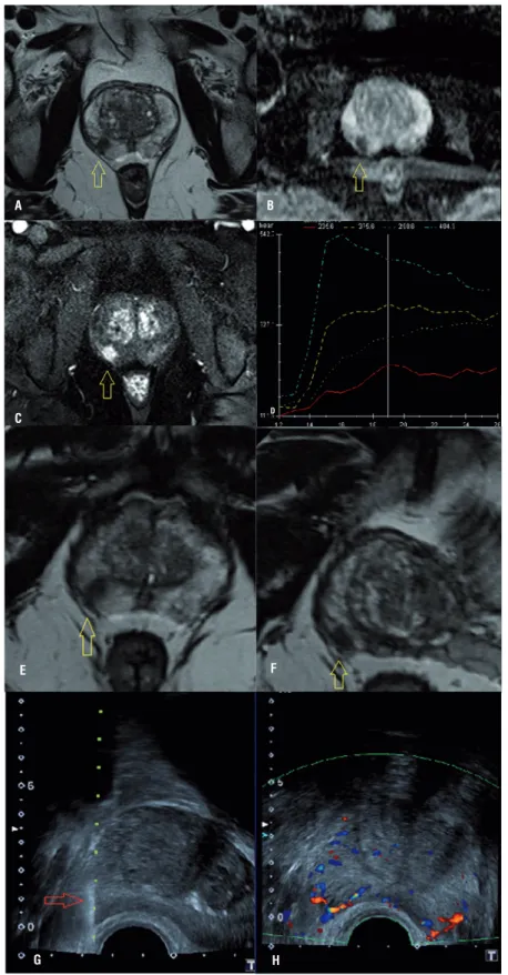 Figure 1 - MpMRI example of a suspicion lesion on the right lobe of peripheral zone of the prostate: A) a round lesion on  T2 weighted-image; B) ADC map shows diffusion restriction; C) dynamic-contrast-imaging with hypervascularization and D)  washout (blu