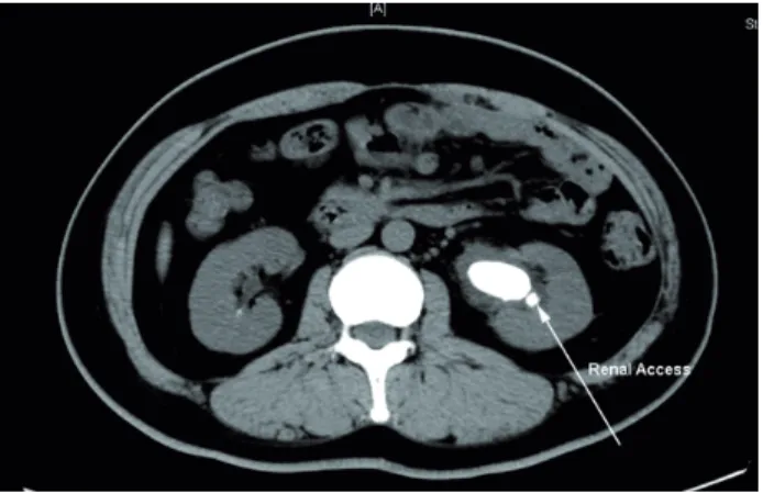 Figure 1 - Left renal stone, measuring 3.2*1.6cm.