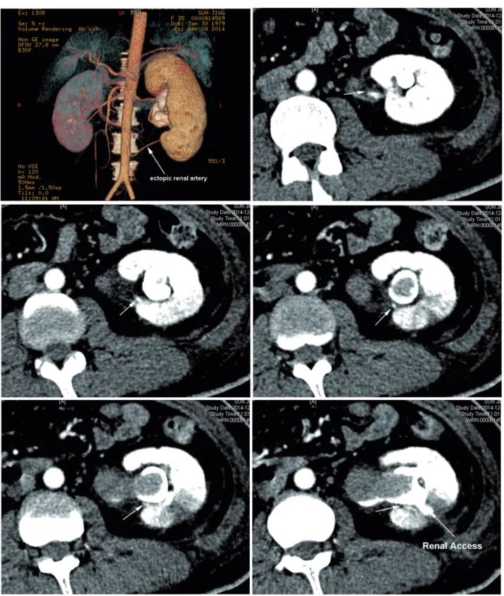 Figure 2 - One ectopic renal artery was found in CT angiography of the left renal artery, and a branch of this artery was near  the renal access.