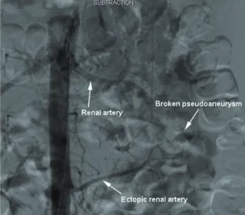 Figure 3 - Rupture of one branch of the ectopic renal artery  angiography.