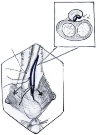 Figure 3a - Buccal mucosa graft placed in position by  quilting over the tunica of corpora cavernosa.