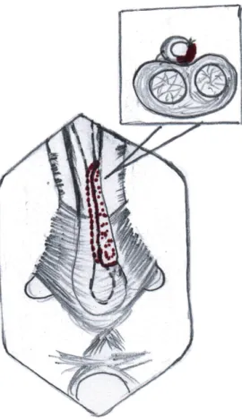 Figure 5 - Completed graft anastomosis.