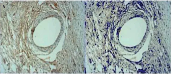 Figure 3 - Example of MMP2 immunoreactivity in an implant sample. Blank rounded area indicates the PP filament