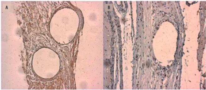 Figure 4 - Example of Il-1 immunoreactivity (Brown area) after 4 days (A) and 30 days (B)–(200x)