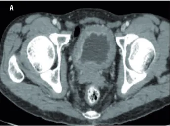 Figure 1 - CT showing enhancing soft tissue lesion in the  urinary bladder suggesting neoplastic lesion.