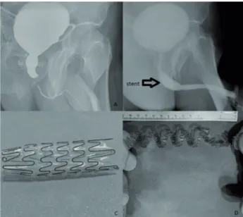 Figure 1 - Radiologic images before and after the urethral  stent replacement and, the views of stent before the  replacement and after removal of it.