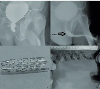 Figure 1 - Radiologic images before and after the urethral  stent replacement and, the views of stent before the  replacement and after removal of it.