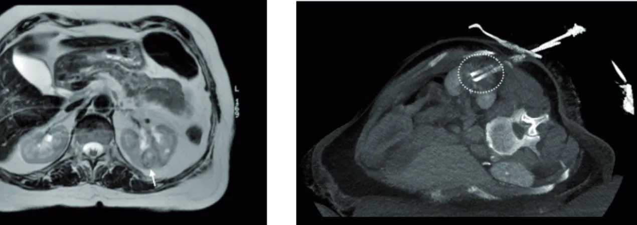Figure 1 - MR image, T2 sequence. Arrow: A biopsy-proven  2.2 cm clear cell carcinoma on the left kidney.